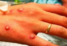 15 ਦਿਨਾਂ ‘ਚ 15 ਦੇਸ਼ਾਂ ‘ਚ ਪਹੁੰਚਿਆ ਮੌਂਕੀਪੌਕਸ