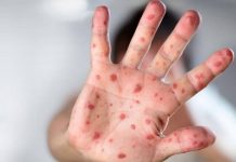 ਜਾਣੋ, ਮੰਕੀਪੌਕਸ ਨਾਲ ਸੰਕਰਮਿਤ ਮਰੀਜ਼ ਨੂੰ ਕਿਹੜੀਆਂ ਚੀਜ਼ਾਂ ਦਾ ਕਰਨਾ ਚਾਹੀਦਾ ਸੇਵਨ ਅਤੇ ਕਿਹੜੀਆਂ ਚੀਜ਼ਾਂ ਤੋਂ ਕਰਨਾ ਚਾਹੀਦਾ ਪ੍ਰਹੇਜ਼