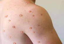 ਦੇਸ਼ ‘ਚ ਮੌਂਕੀਪਾਕਸ ਪਹਿਲਾ ਮਾਮਲਾ ਆਉਣ ਤੋਂ ਬਾਅਦ ਕੇਂਦਰ ਸਰਕਾਰ ਅਲਰਟ, ਜ਼ਰੂਰੀ ਦਿਸ਼ਾ-ਨਿਰਦੇਸ਼ ਕੀਤੇ ਜਾਰੀ