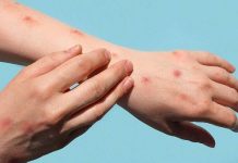 ਦੇਸ਼ ‘ਚ Monkeypox ਦਾ ਤੀਜਾ ਮਾਮਲਾ ਆਇਆ ਸਾਹਮਣੇ