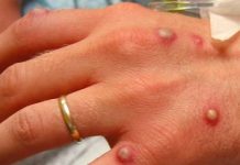 ਕੇਰਲ,ਦਿੱਲੀ ਤੋਂ ਬਾਅਦ ਮੱਧ ਪ੍ਰਦੇਸ਼ ‘ਚ ਵੀ ਮੰਕੀਪਾਕਸ ਨੇ ਦਿੱਤੀ ਦਸਤਕ