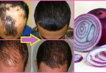 ਜੇਕਰ ਤੁਸੀਂ ਵਾਲਾਂ ਦੇ ਝੜਨ ਤੋਂ ਪਰੇਸ਼ਾਨ ਹੋ ਤਾਂ ਪਿਆਜ਼ ਦੇ ਇਸ ਹੇਅਰ ਮਾਸਕ ਨੂੰ ਲਗਾਓ